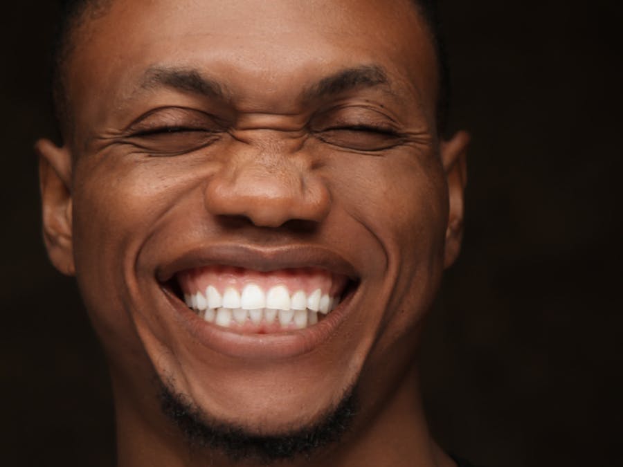 Riabilitazione Implantologica Arcata Superiore - Dopo