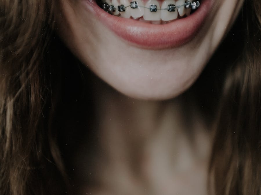 Ortodonzia Adulto - Correzione Morso Aperto - Prima