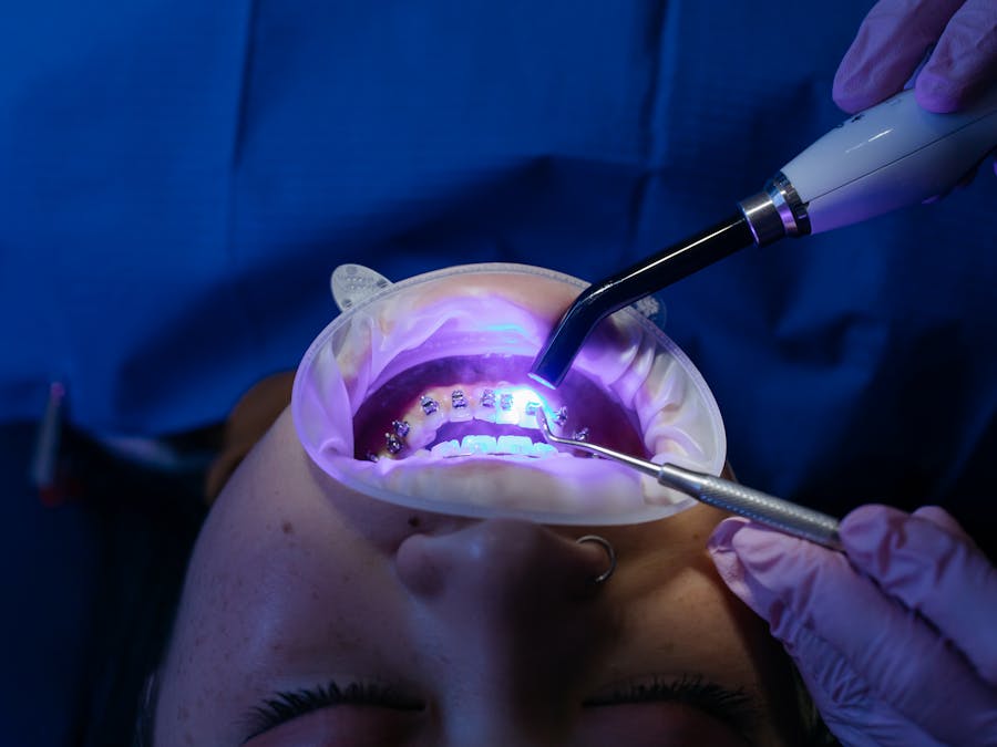 Bruxismo Severo - Ricostruzione Occlusale - Prima